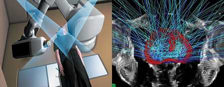 advantages of CyberKnife advantages of CyberKnife