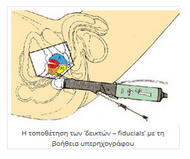 Πλεονεκτήματα CyberKnife® Πλεονεκτήματα CyberKnife®