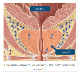 Πλεονεκτήματα CyberKnife® Πλεονεκτήματα CyberKnife®